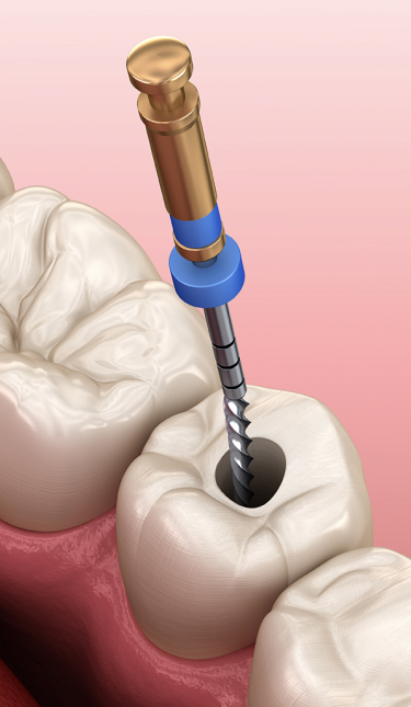Root Canal Treatment